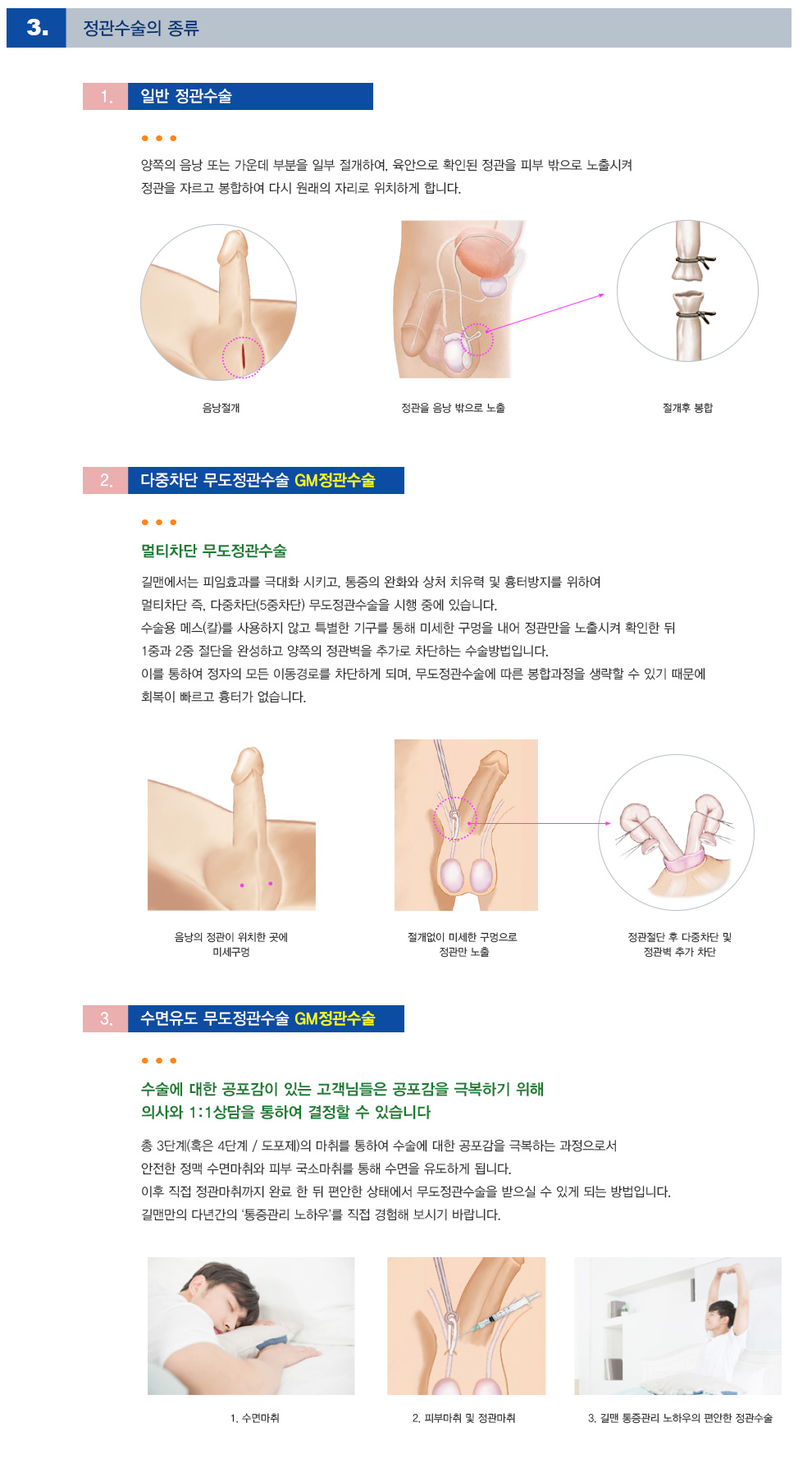 GM정관수술